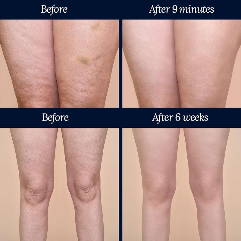 ADONIA LEGTONE – Natural cellulite cream – Organic cellulite treatment – Anti cellulite products - Soothes, relaxes, tightens, and firms the skin